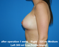 plastic-surgery-breast-augmentation